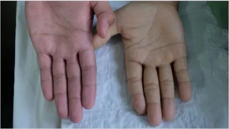 How Anaemia Affect Pregnancy